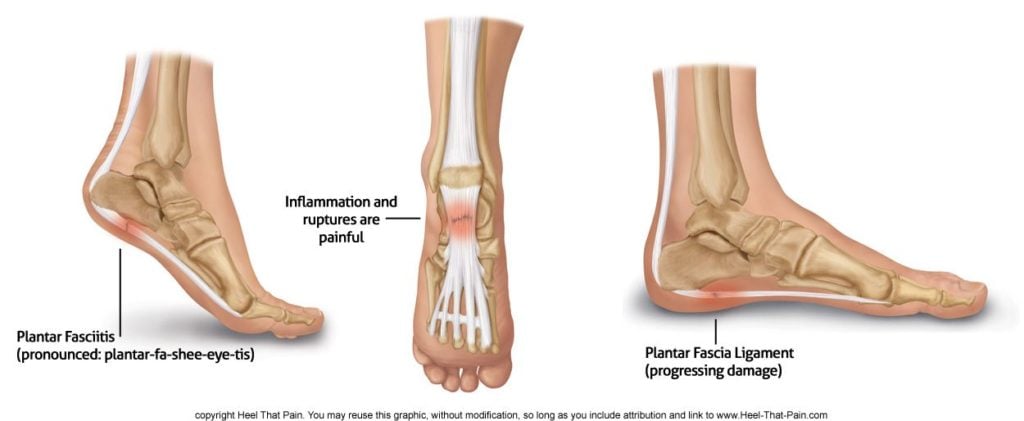 Heel Pain Causes, Treatments, and Home 