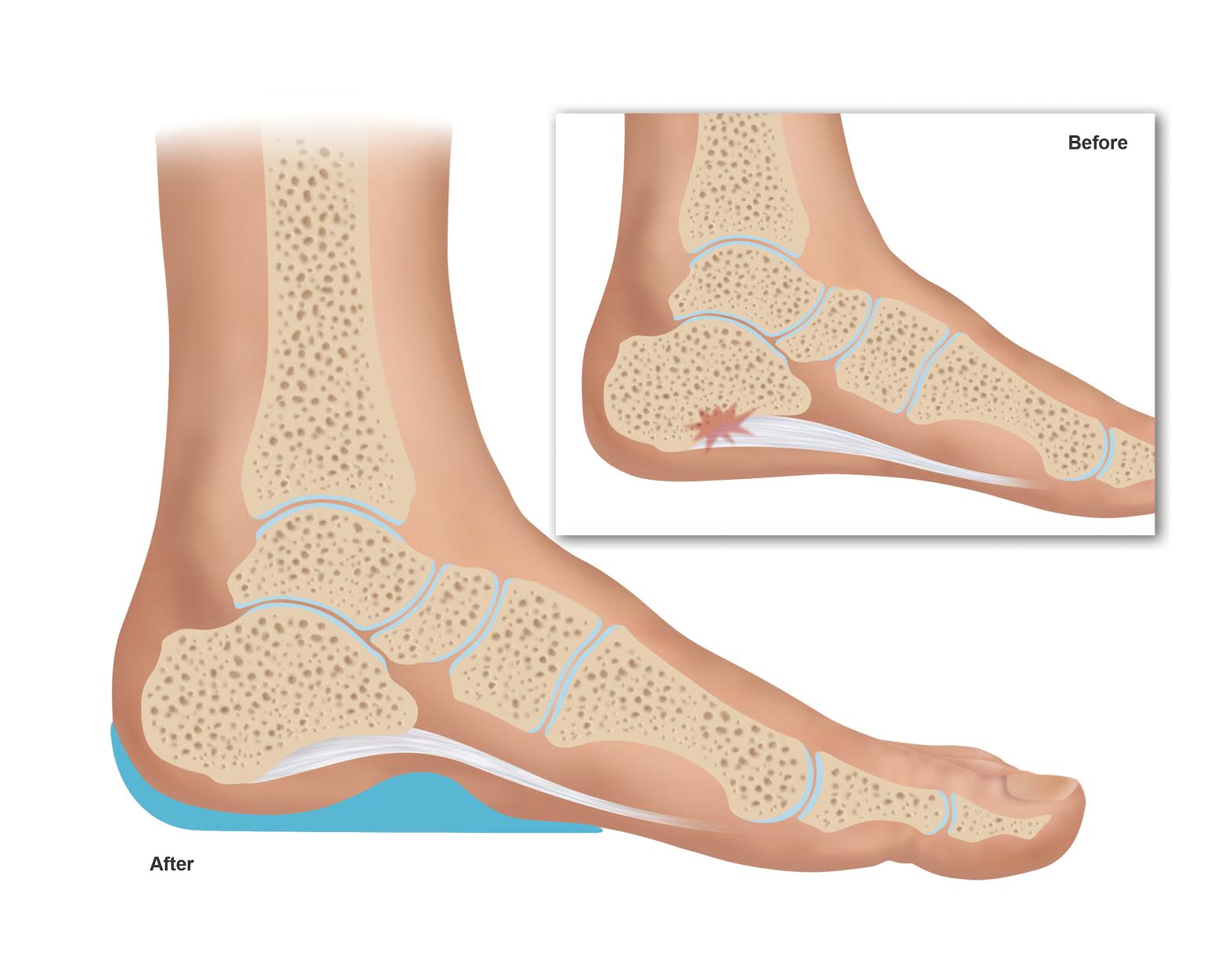 What are Heel Spurs? Learn Symptoms 