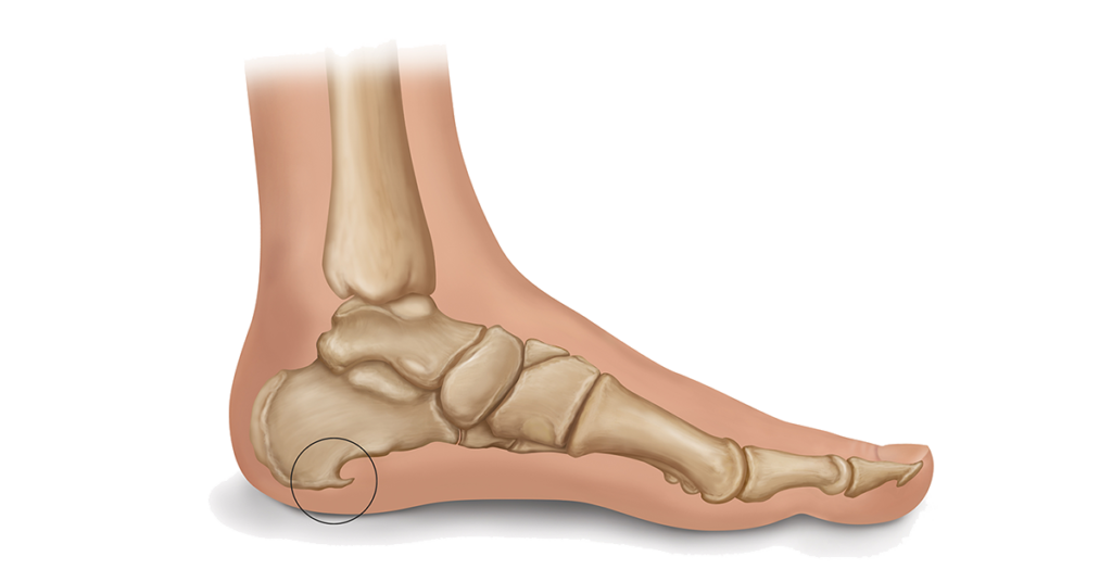 slippers for calcaneal spur