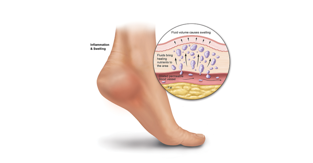 plantar calcaneal bursitis