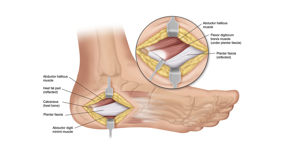 Plantar Fasciitis Surgery and Recovery