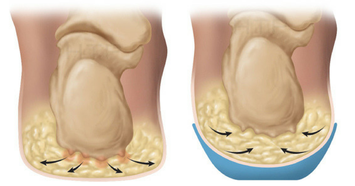 Heel Fat Pad Syndrome and Treatment 