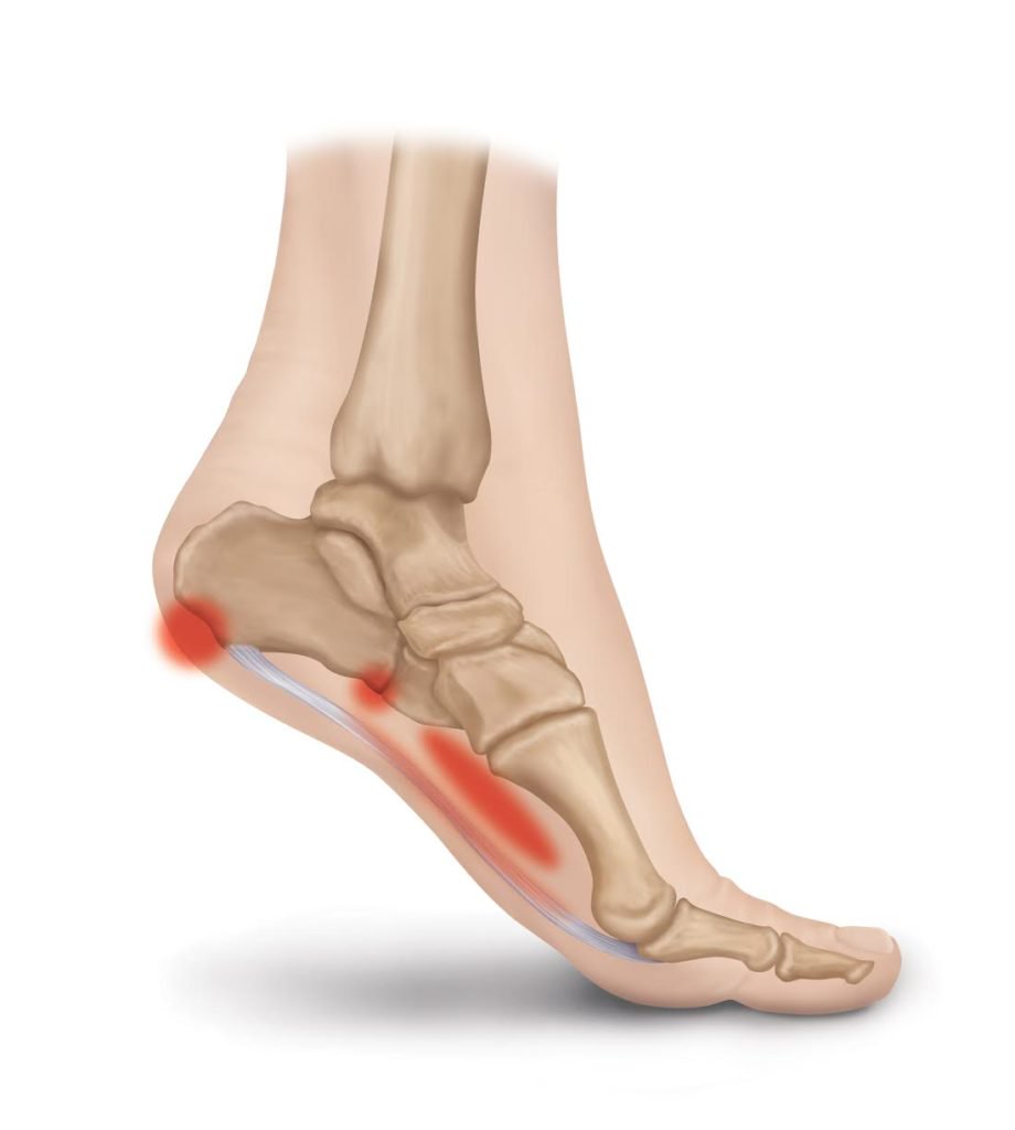 heel arch pain