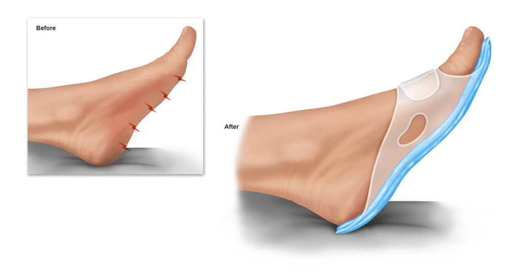 before and after illustration with ice slippers