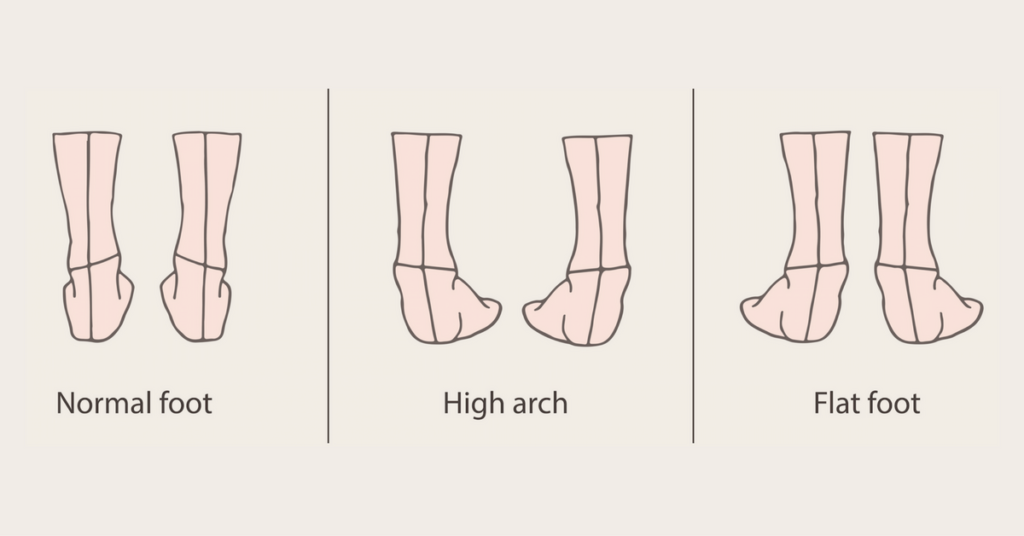Chart of different type of flat feet