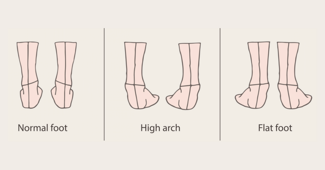 Learn Your Foot Arch Type With The Wet Test | Heel That Pain