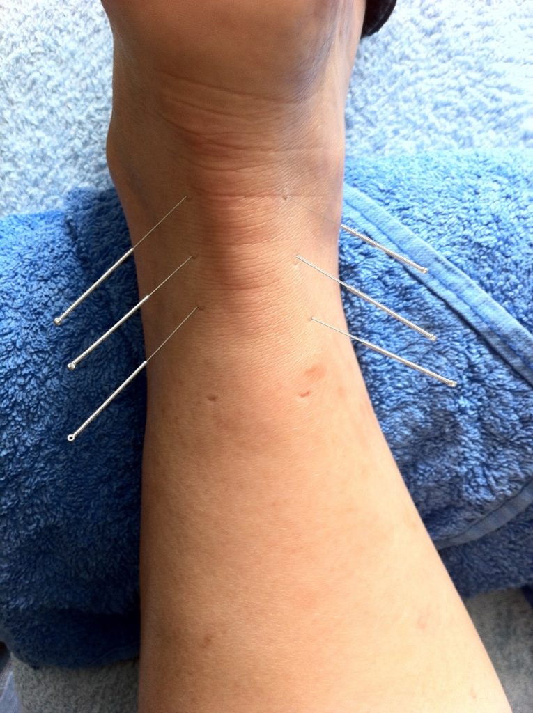 Acupuncture in the foot