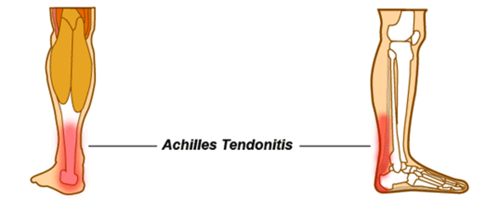 achilles tendon sore after sleeping