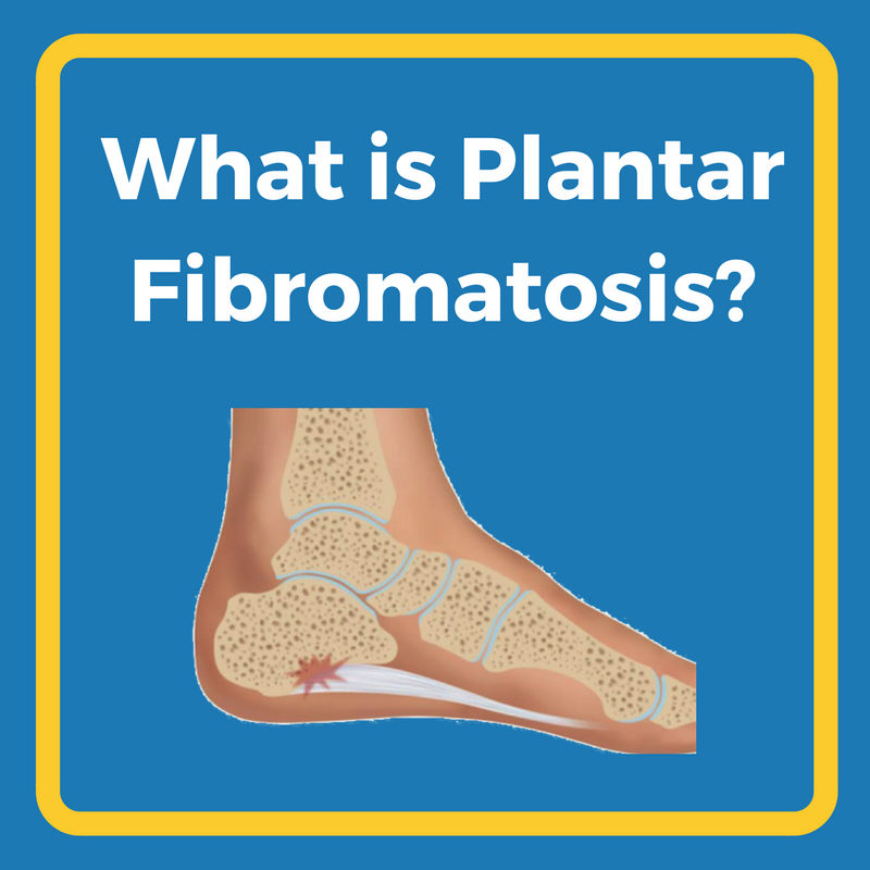 Foot orthotic clearance for plantar fibroma