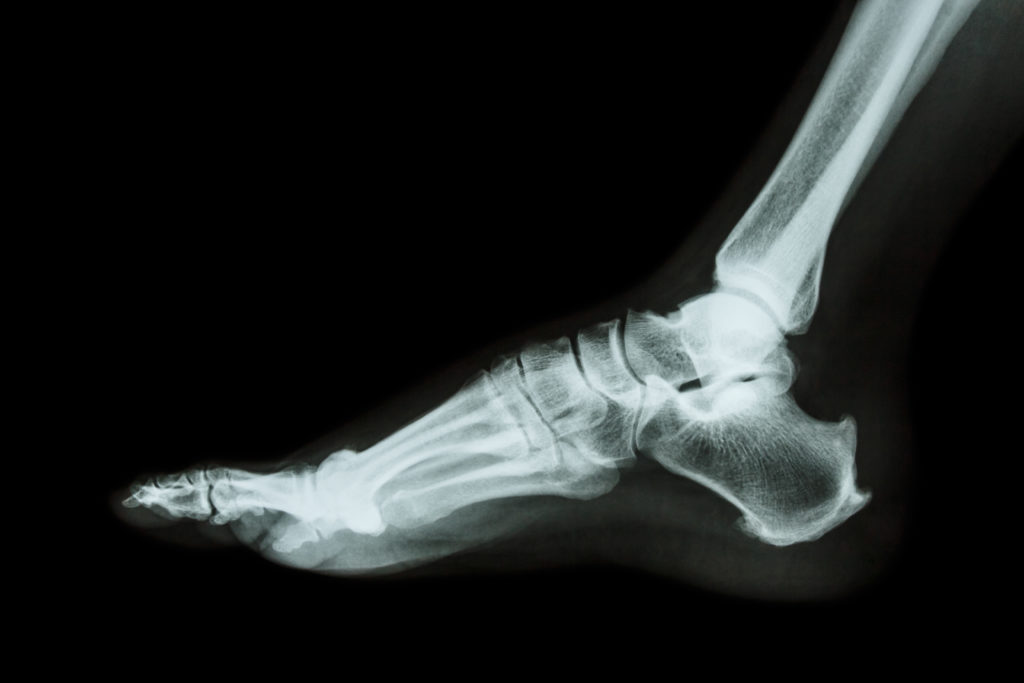 spurs x ray ankle