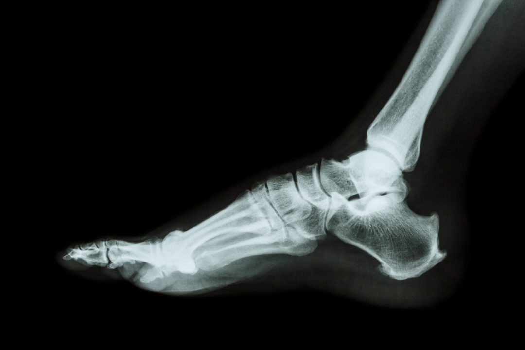 Everything You Need to Know About Xrays for Heel Pain Heel That Pain