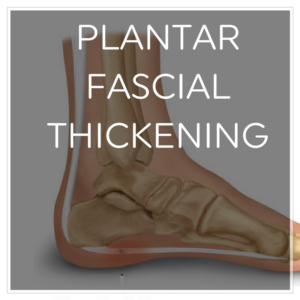 Plantar fascial thickening illustration