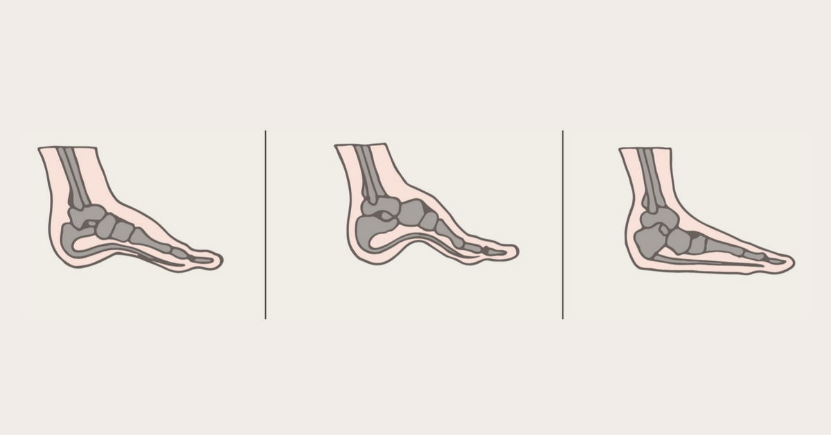 What is Overpronation? Causes and Treatments