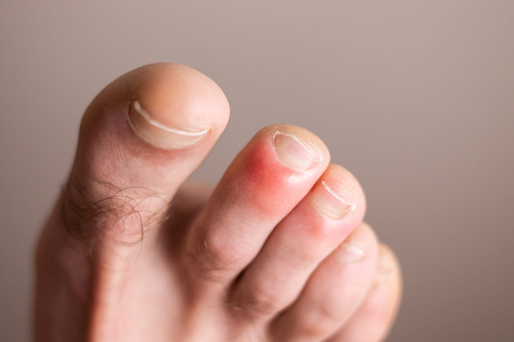 a foot with a red swollen second toe